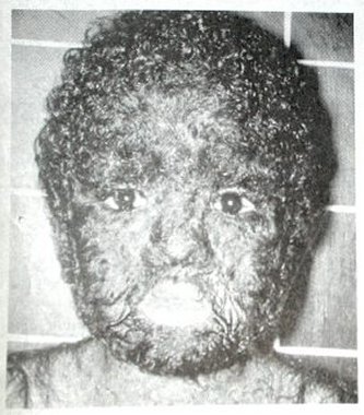 Man with pelt growth